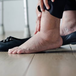 Kaki Bengkak Penderita Diabetes, Apa Sebabnya?