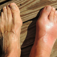 Kamu Asam Urat atau Rematik? Kenali Perbedaannya!