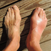 Kenapa Orang dengan Diabetes Berisiko Kena Asam Urat?