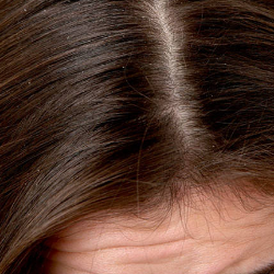 Ketombe Tak Kunjung Hilang, Mungkinkan Psoriasis?