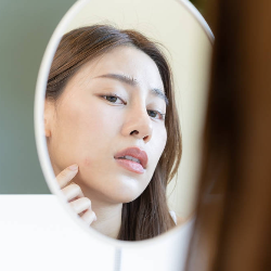 Mengatasi Jerawat dengan Skincare Berbahan Sulfur