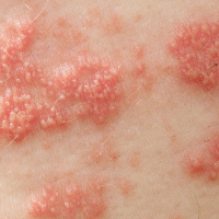 Mengenal Cacar Api, Kondisi yang Bisa Muncul setelah Cacar Air