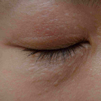 Cara Mengobati Bintik Putih di Sekitar Kelopak Mata atau Syringoma