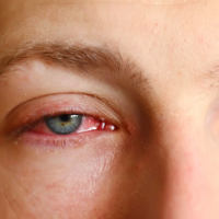 Mitos dan Fakta Penyebab Pembuluh Darah Mata Pecah