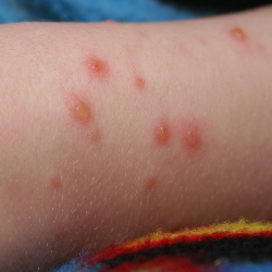 Waspada Potensi Penyakit Cacar Monyet Masuk ke Indonesia