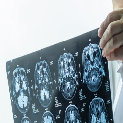 Mengenal Penyakit Moyamoya: Kelainan Pembuluh Darah Otak Penyebab Stroke