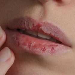 Penyebab Bibir Pecah-Pecah, Benarkah Kurang Vitamin?