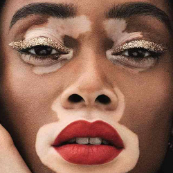 Penyebab dan Cara Mengobati Vitiligo