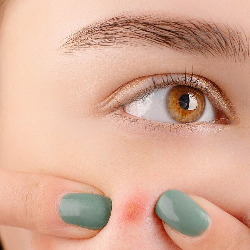 Penyebab Munculnya Jerawat Setelah Melahirkan