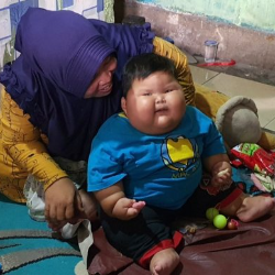 Penyebab Obesitas Kenzi Bukan Kental Manis, Diduga Kelainan Genetik