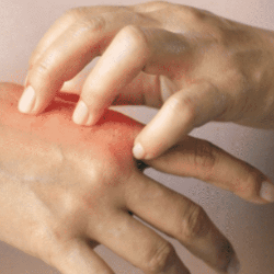 Gatal di Kulit, Apa Sebabnya?