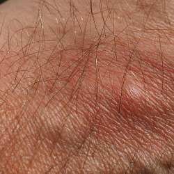 Ini Perbedaan Alergi dan Intoleransi Makanan