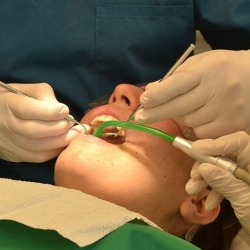 Mengapa Perlu Perawatan Saluran Akar Sebelum Gigi Ditambal?