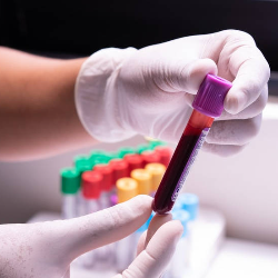 Benarkah Risiko Diabetes Ada Kaitannya dengan Golongan Darah?