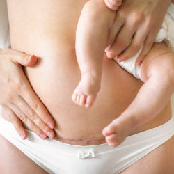 Hal-hal yang Perlu Mums Ketahui Seputar Pemulihan Persalinan Caesar