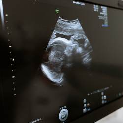 Sonohisterografi, USG Rahim yang Penting Jika Tak Kunjung Hamil