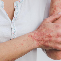 Tanda Diabetes pada Kulit yang Jarang Disadari