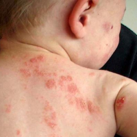 Tanda Alergi pada Kulit Anak