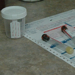 Waspadai Glikosuria, Gejala Umum Diabetes dan Kerusakan Ginjal