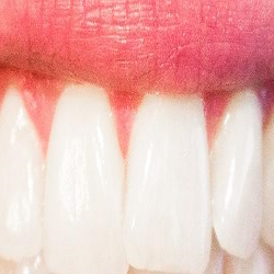 Bercak Putih di Rongga Mulut? Waspadai Infeksi Jamur